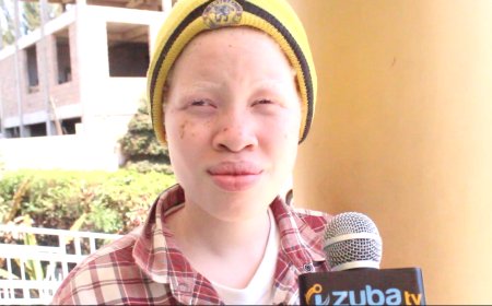 KIGALI :Ntibikiri imbogamizi  kubona amavuta y’abafite ubumuga bw’uruhu