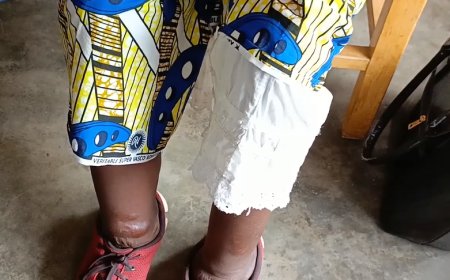 MUSANZE :Abarwayi b’imidido baracyahabwa akato